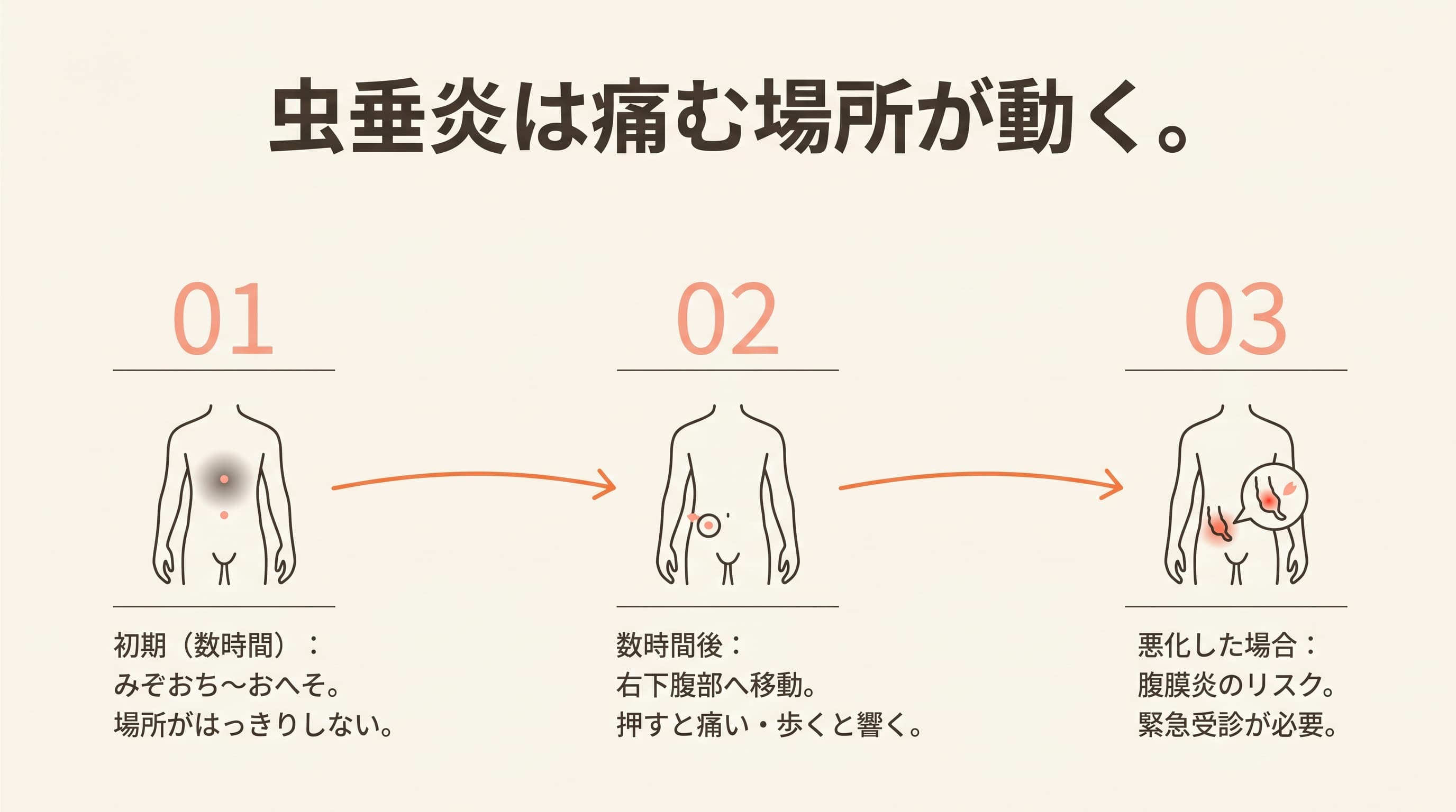 虫垂炎は痛む場所が動く。みぞおちから右下腹部へ痛みが移動する図版。